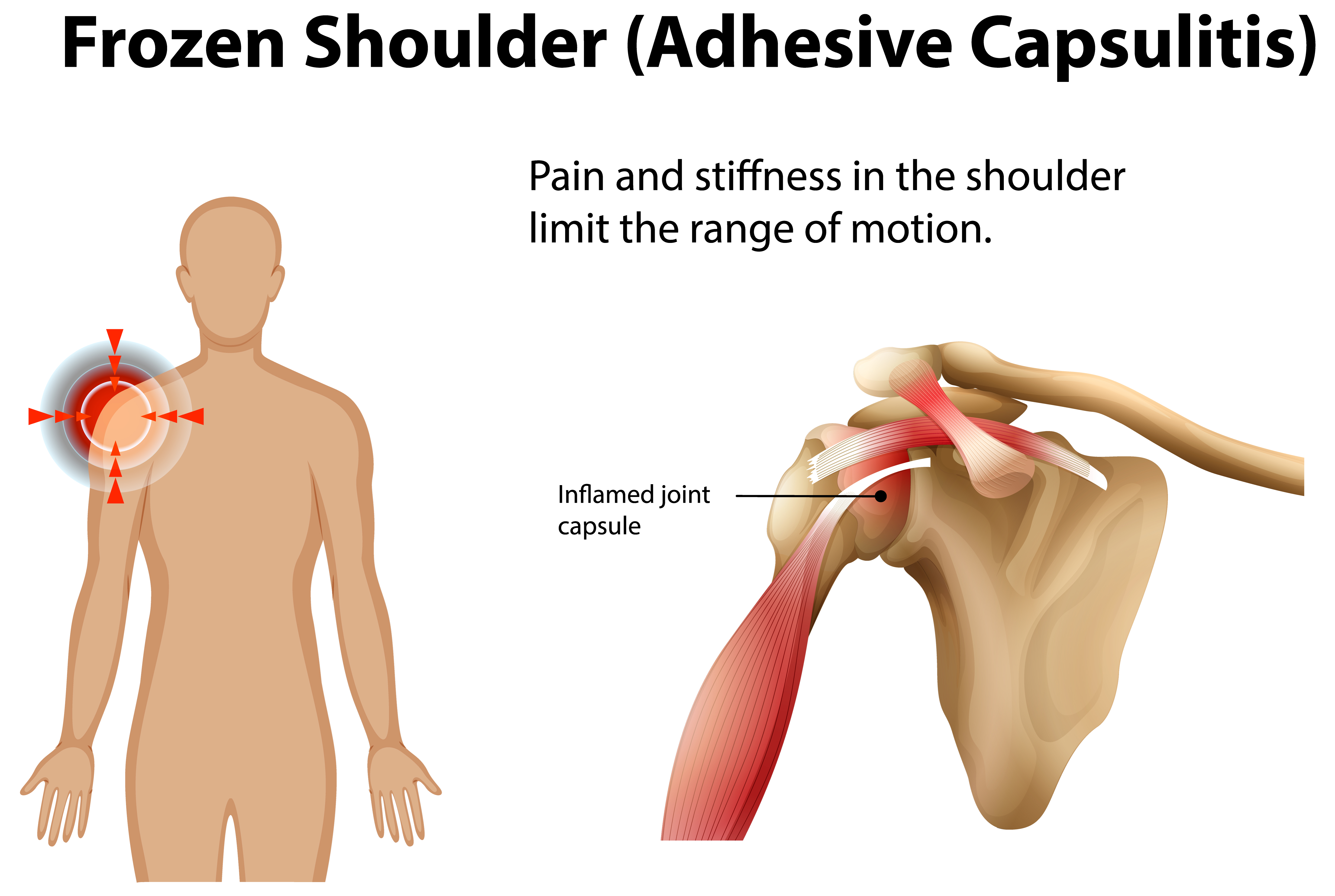 Ayurvedic frozen shoulder treatment
