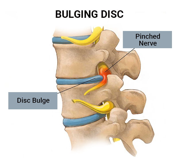 Ayurvedic treatment for disc bulge