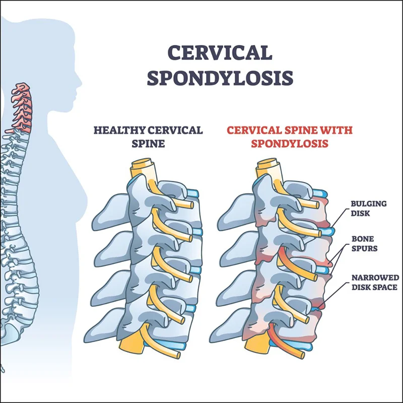 Ayurvedic treatment for cervical spondylosis