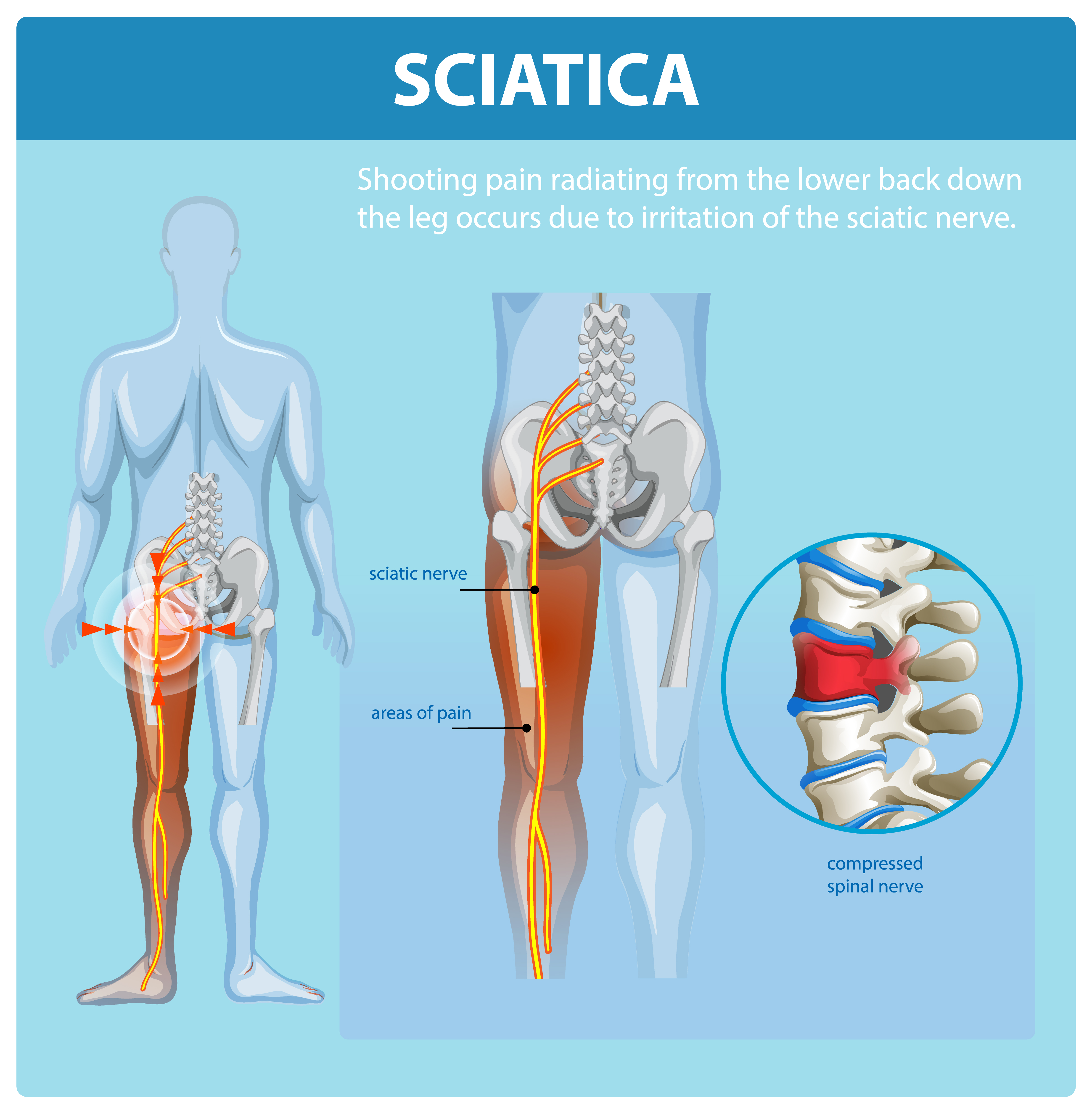 Ayurvedic treatment for sciatica