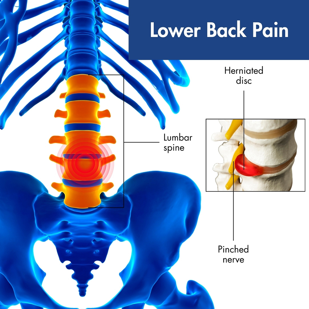 Ayurvedic treatment for low back pain